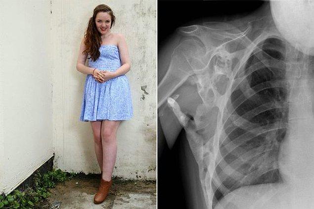 Hastalığa sahip olan insanlardan bir tanesi, 18 yaşındaki İngiliz kadın Seanie Nammock.