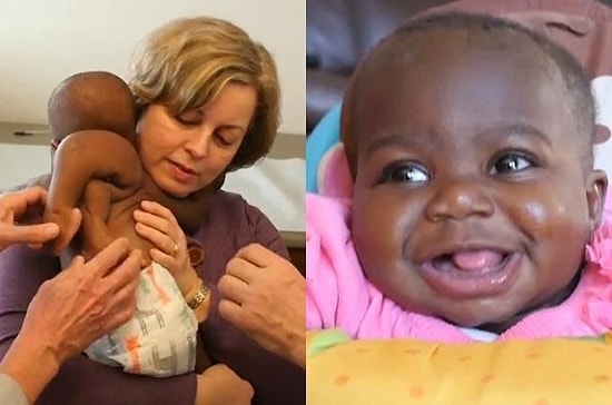 Dört Ayakla Dünyaya Gelen ve Parazitik İkizinden Ayrılmak İçin Ameliyat Olan Minik Bebek