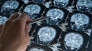 Alzheimer Tedavisinde Hafıza Fonksiyonlarını Yenileyen Çığır Açacak Bir Yöntem Geliştirildi!