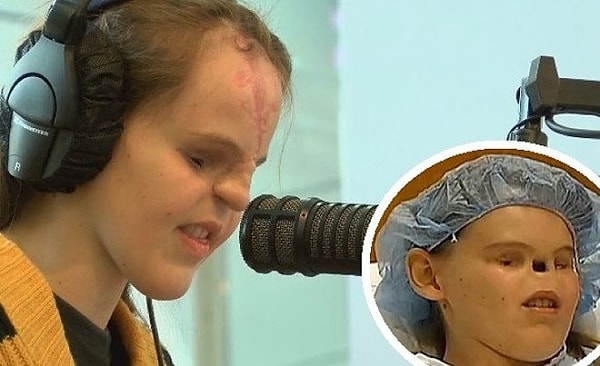 5. Кэссиди Хупер – девочка родившаяся без носа и глаз