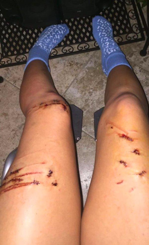 Genç softbol oyuncusu, Florida kıyısında uğradığı şok edici köpek balığı saldırısından sonra "hayatta olmasının şanstan da öte" olduğunu kabul etti.