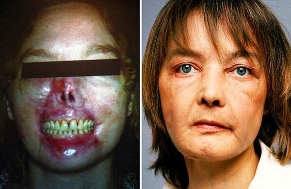 12. Kendi köpeğinin saldırısına uğrayan Dinoire'nin yüzünün bir bölümü parçalanması nedeniyle 2005 yılında kadavradan alınan bir yüz bir hastanede kısmi yüz nakli ameliyatıyla takılmış, bu da tıp tarihindeki ilklerden olmuştur.