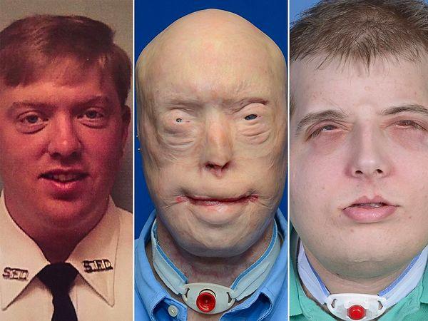 1. Patrick Hardison was the first person who had an extended-facial transplant in the world.