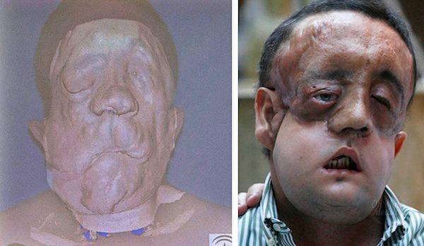 2. This man, known only as Rafael, is a Spanish farmer suffering from neurofibromatosis, received a partial-face transplant in 2010.