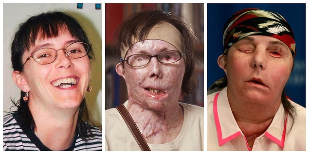 3. 80% of Carmen Blandin's face was burned because her ex-husband threw nitric acid on her face. She had a facial transplant in 2015.