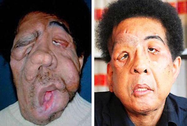 6. Pascal Coler, of France, was severely disfigured by neurofibromatosis, a genetic disorder causing benign tumors to grow on his face. He received a nearly full-facial transplant in 2007.