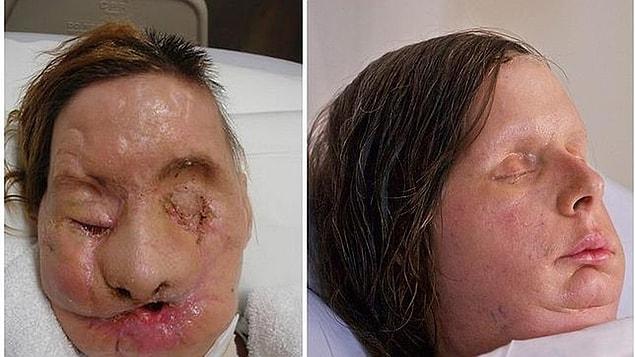 9. Charla Nash, of Connecticut, had most of her face ripped off by a friend's chimpanzee. Charla received a full-face transplant in 2011.