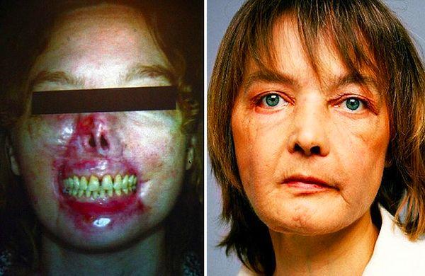 12. Isabelle Dinoire, of France, lost much of her face when she was mauled by her dog. She became the first person in history to successfully receive a partial face transplant in 2005.