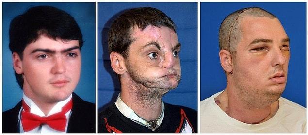 13. Andy Sandness, who suffered a severe depression in 2006, attempted to commit suicide by putting a rifle on his jaw and pulling the trigger.