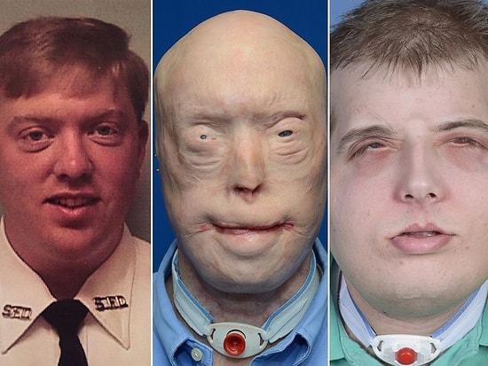 13 Before And After Photos Of People Who Had Facial Transplants