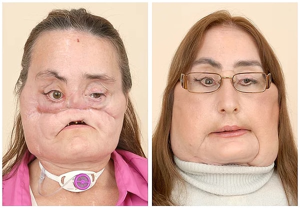 11. Конни Калп, Огайо. Она была на грани смерти после того, как ее муж выстрелил ей в лицо. Ей была сделана полная пересадка лица в 2008 году