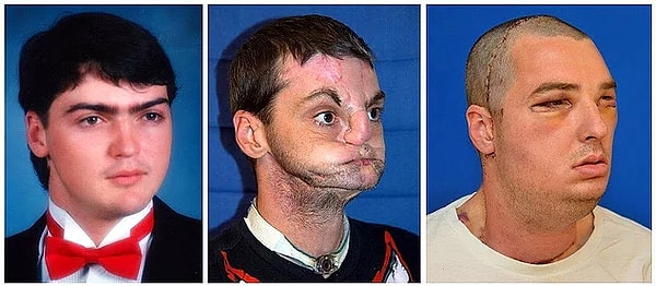 13. Энди Санднесс страдал от тяжелой депрессии в 2006 году. Парень выстрелил себе в лицо. Прошло 11 лет прежде чем ему смогли сделать трансплантацию лица