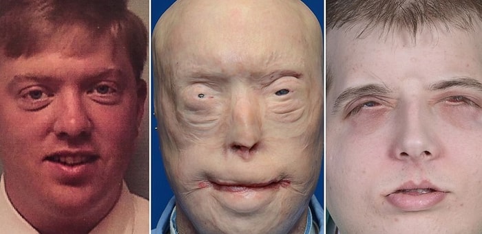 13 фотографий людей ДО и ПОСЛЕ трансплантации лица