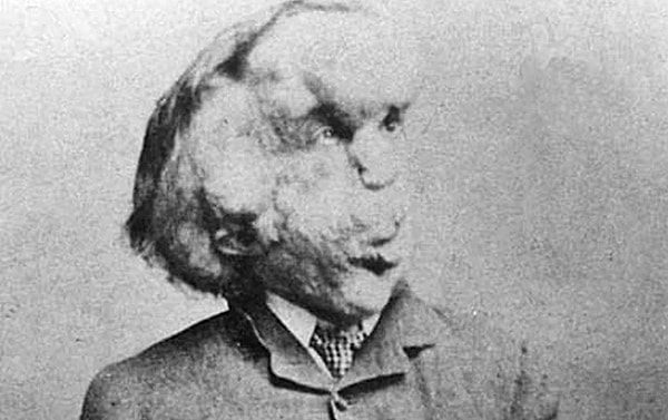 4. Джозеф Меррик