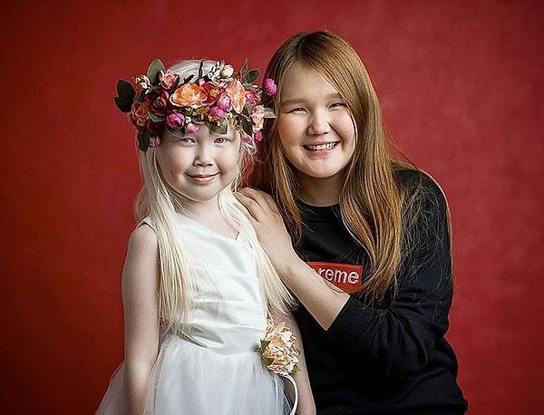 Hem anne hem de baba tarafındaki bütün bireyler içerisinde albino olarak dünyaya gelen Nariyana. Ailesinde de tek sarı saçlı olan ayrıca.