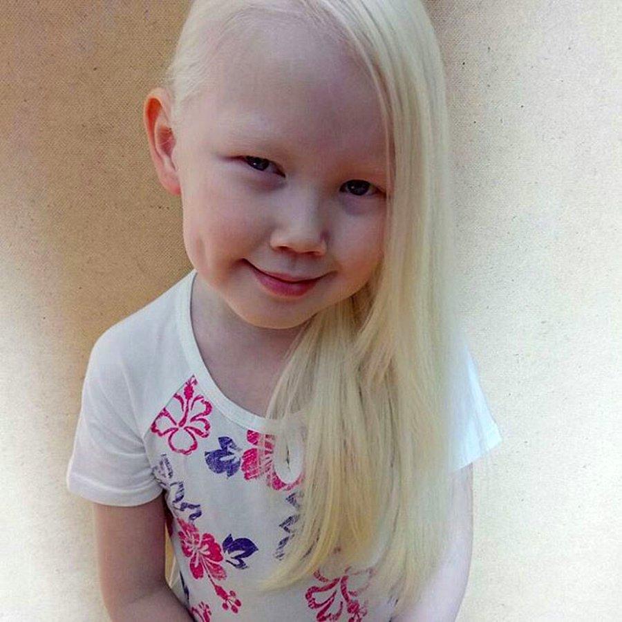 Якутская девочка альбинос