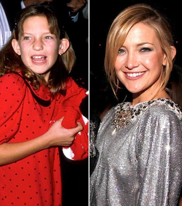 3. Kate Hudson, actress Goldie Hawn's daughter, was born into Hollywood. She has also went through some operations before she became a successful actress.
