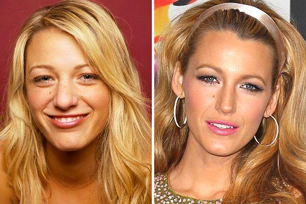 6. Former Gossip Girl star, Blake Lively is one of those people who had surgery before they reached the age of 20.