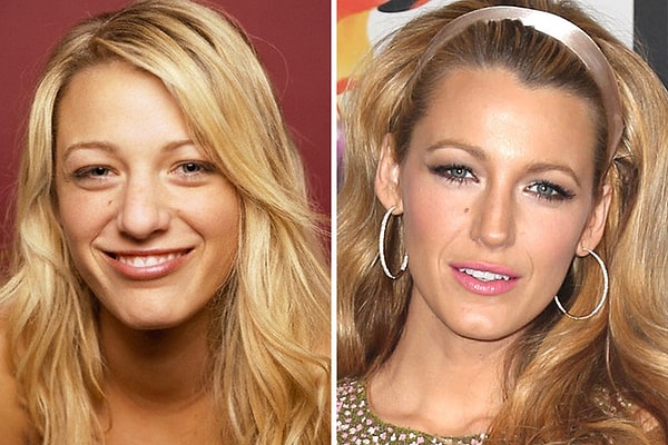 6. Former Gossip Girl star, Blake Lively is one of those people who had surgery before they reached the age of 20.