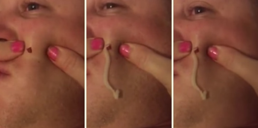 Kocasının Suratındaki 4 Yıllık Kisti Sıkarken İçinden Dünyaları Fışkırtan Kadın