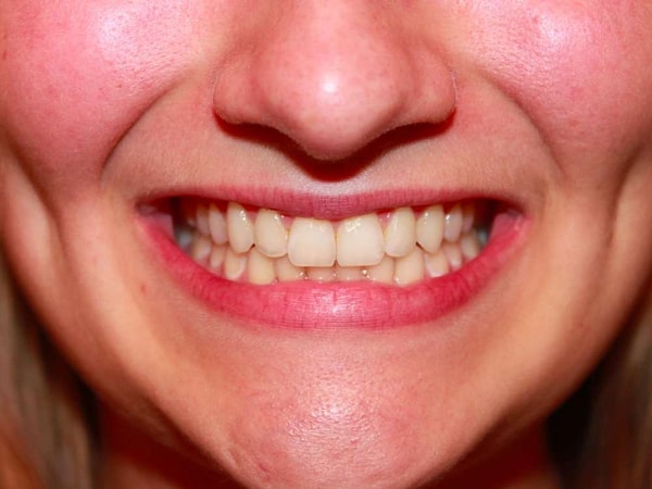 7. Выпадающие зубы