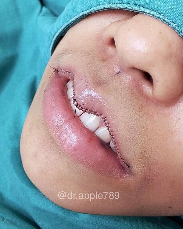 1. Поприветствуйте новый тренд: уменьшение губ и придание им изогнутой формы! И угадайте, где все началось? Правильно, в Азии! Оказывается, у юных азиаток губа, изогнутая в форме стрелкового лука, считается очень красивой.