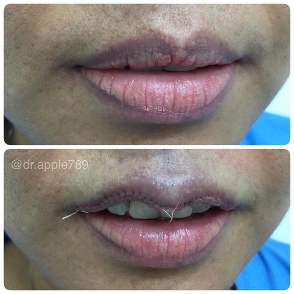 2. Для придания губе такой формы из нее удаляется часть кожи вдоль слизистой линии, с помощью швов создается новый контур, а после губу "подгибают" внутрь, чтобы уменьшить размер.