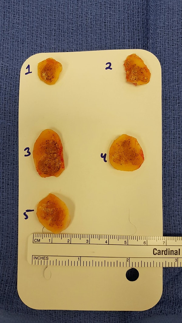 1. Парень из Техаса подхватил тяжелейшую инфекцию после принятия душа в спортзале босиком