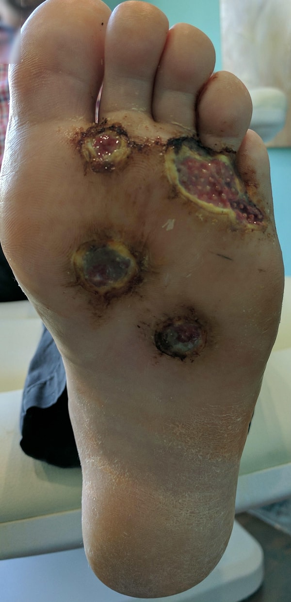 6. Он прошел через кожную трансплантацию, используя трансплантаты, изготовленные из атлантической трески