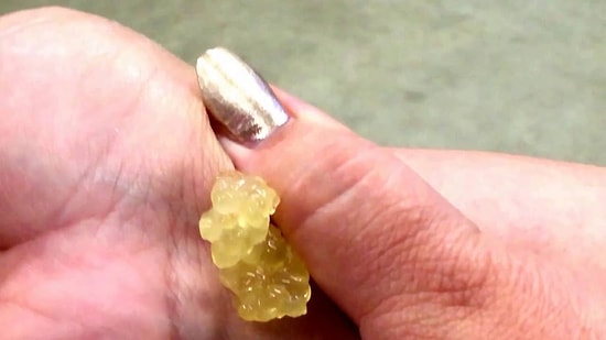 Bileğindeki Ganglion Kistini Patlatarak İçinden 'Jölemsi' Bir Sıvı Çıkartan Kadın