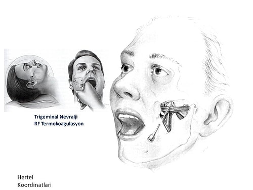 İnsanı İntihara Sürükleyecek Kadar Şiddetli Ağrılara Sebep Olan Hastalık: Trigeminal Nevralji