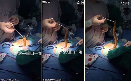 Makatına Yılan Balığı Sokan Rahatsız Çinli