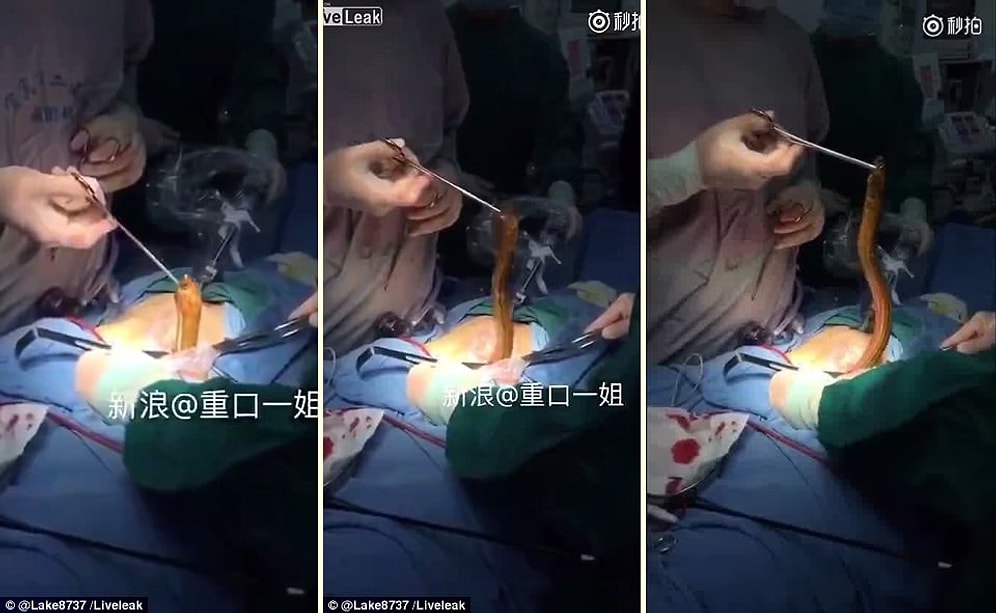 Makatına Yılan Balığı Sokan Rahatsız Çinli