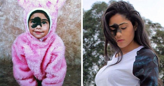 Девушка, родившаяся с большим пятном на лице, отказывается его убирать, и вот почему...