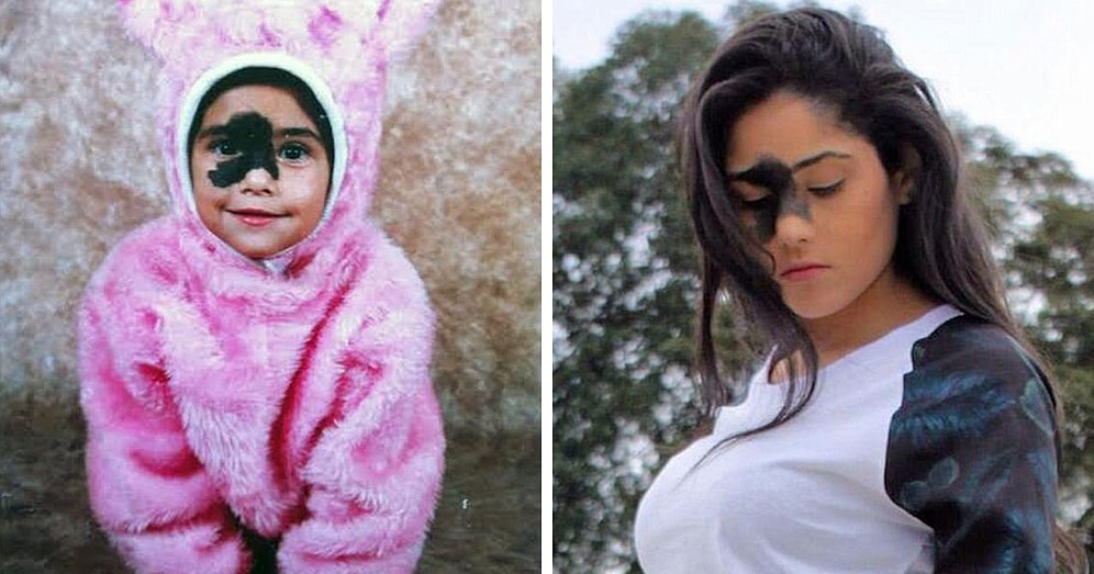 Yüzündeki Siyah Doğum Lekesini Aldırmak Yerine Onunla Barışmayı Tercih Eden Cesur Kadın