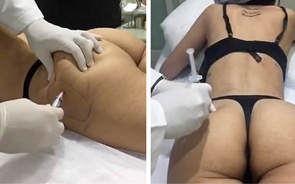 3. Совсем недавно Дженнифер вкачали жир с живота в попу.