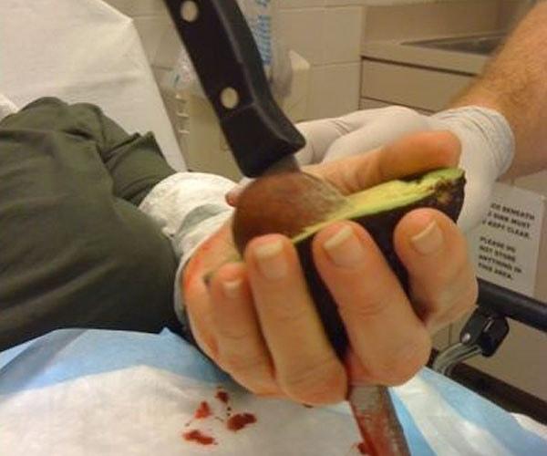 Özellikle Instagram'a ''avocado injuries'' yazdığınız zaman bir sürü yaralanma fotoğrafı ile karşılaşacaksınız. Şu gördüğünüz de onlardan biri.