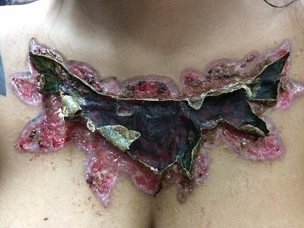 7. "После того как я воспользовалась ремувером, у меня сразу начались боли. Кожа отходила очень долго и болезненно. Это было похоже на пытку, я не могла спать"