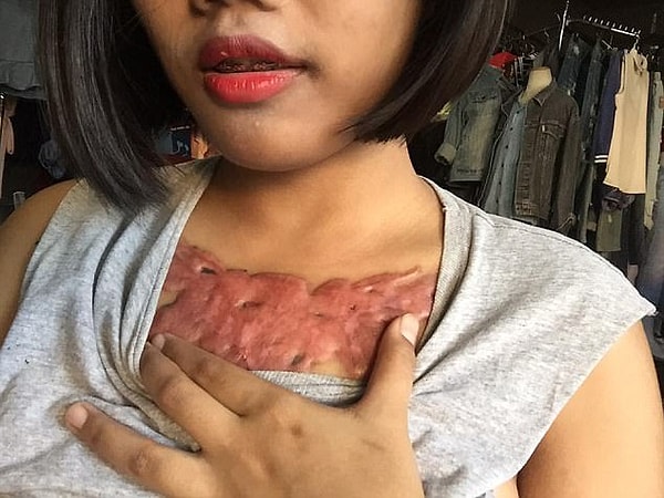 9. 7 мая огромный розовый шрам все еще оставался на груди девушки