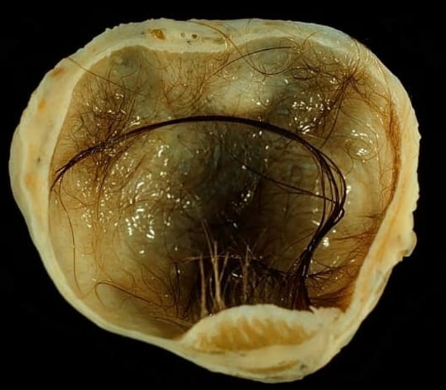 14. Some tumors can grow teeth, be filled with hair, or develop organs of their own. Seriously.