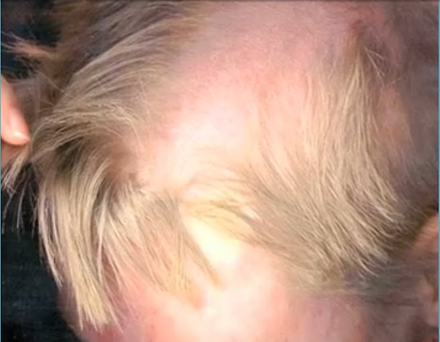 Despite being named by a dermatologist, trichotillomania is not classified as a dermatological disease.