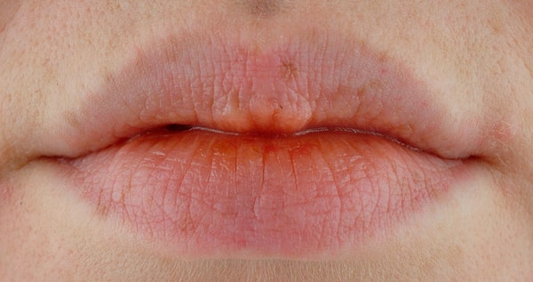 4. Бледные губы