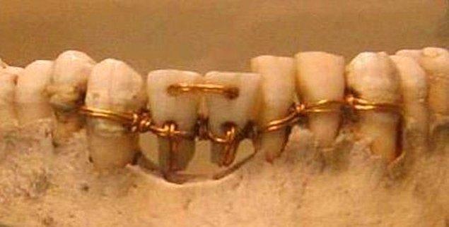 18. 4000 yıllık diş tedavisi.