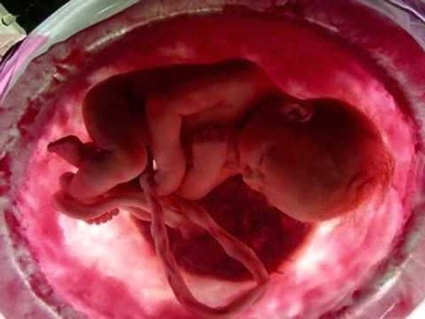 11. Çoğu vakada, fetüs kürtaj sırasında ağrıyı hissetmiyor.
