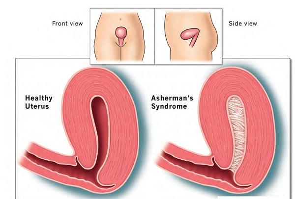 4. Yapışıklık (Asherman) sendromu rahmin fazlaca kazınması ve eski kürtaj yöntemleri kullanılması sonucunda oluşuyor.