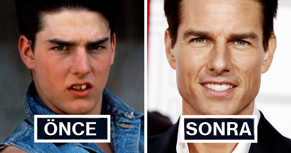 Nefret Etseniz de Diş Teli Takınca Yaşanan Çılgın Değişimi Gösteren 22 Fotoğraf