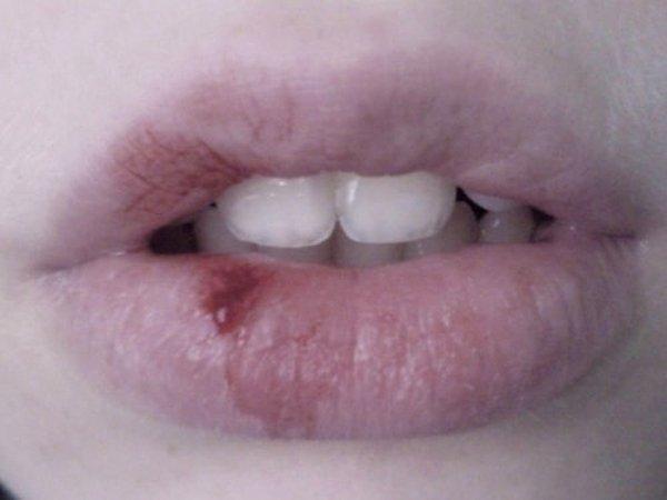 Soluk renkte dudaklar kan değerlerinizde ve vücudunuzdaki demir oranında düşüş olduğuna işaret eder.