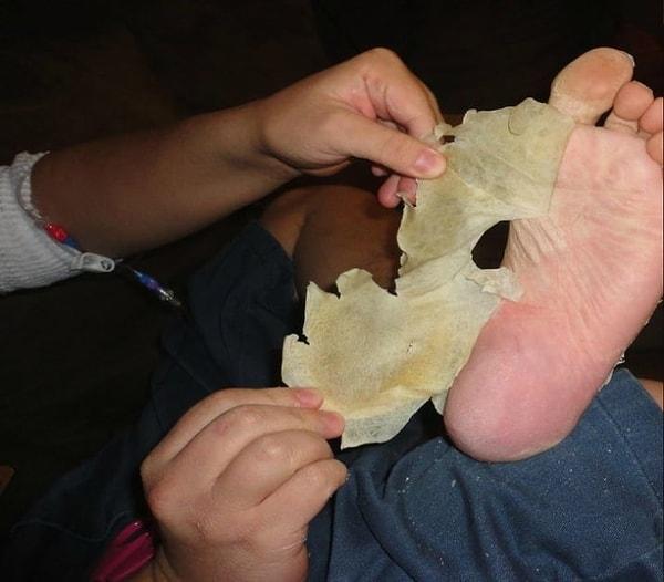 9. Kimyasal peeling kullanarak ayaklardaki ölü derinin tamamını çıkarmak.