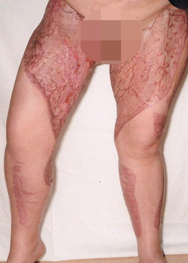 Hastaneye götürüldüğünde, bakterilerin bacaktaki yumuşak dokuya zarar verecek toksinler salgıladığını söylediler.