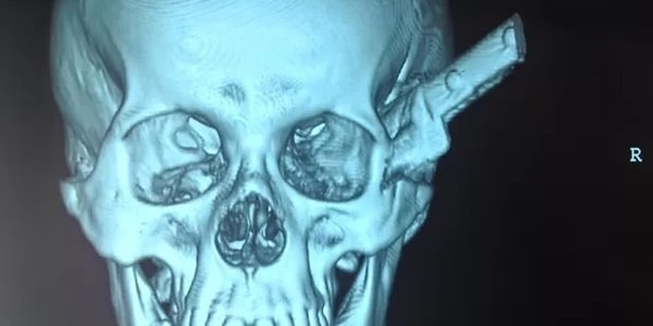 1. "Лучше вытащить вонзившийся нож, чем оставлять его внутри"